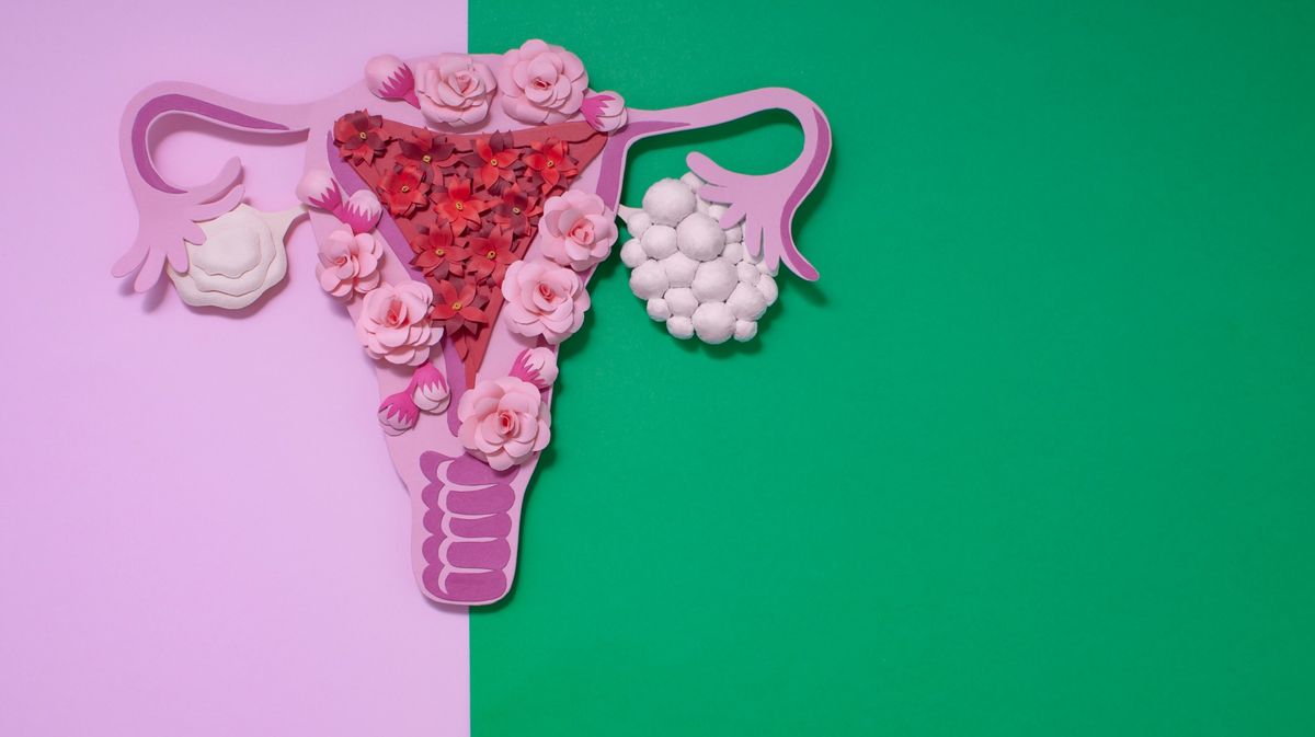 polycystic-ovary-syndrome-myths-treatments