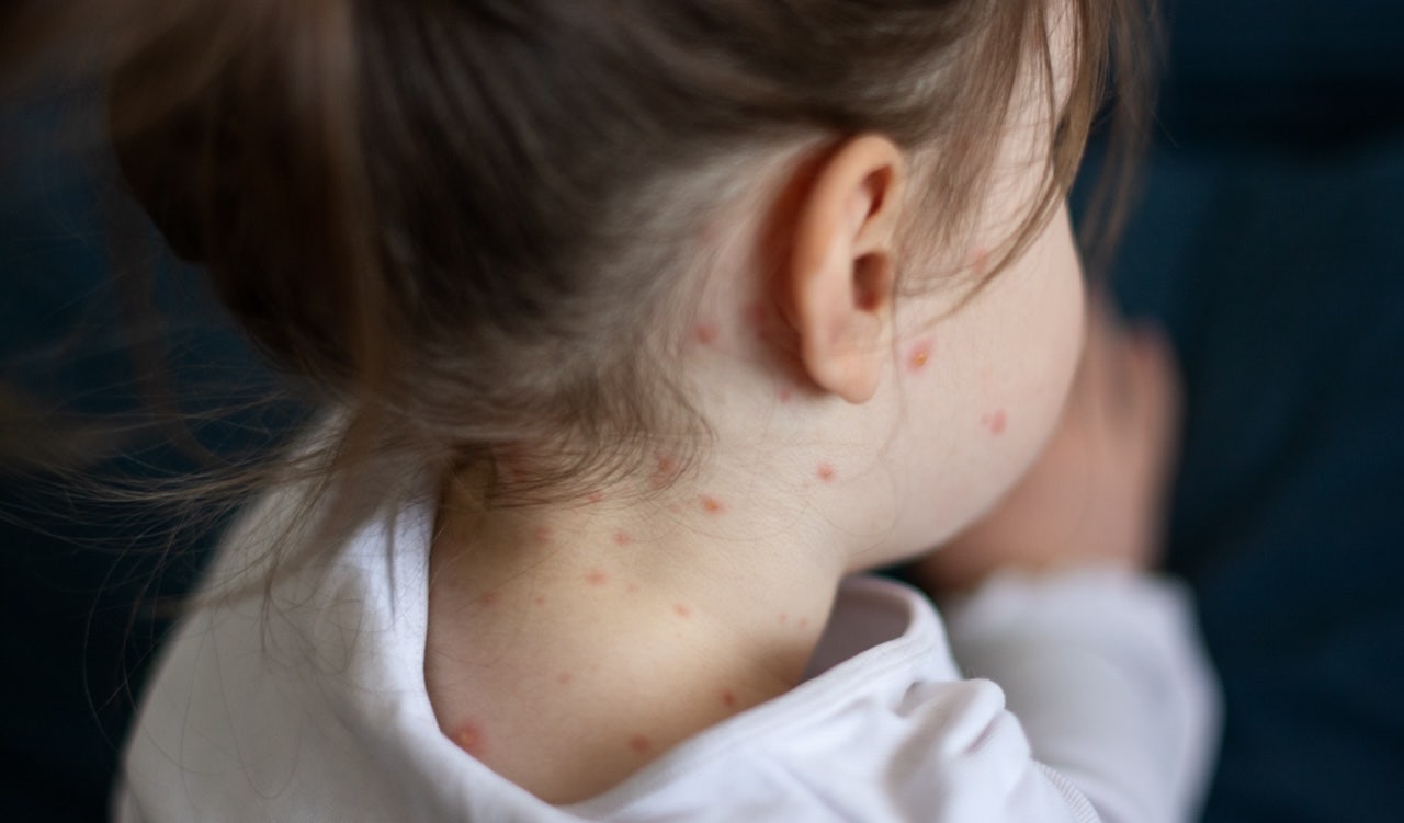 measles-outbreak-public-health
