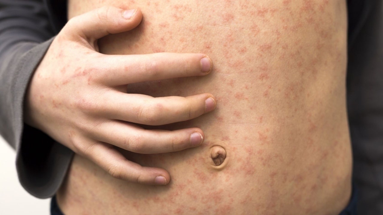 texas-measles-outbreak