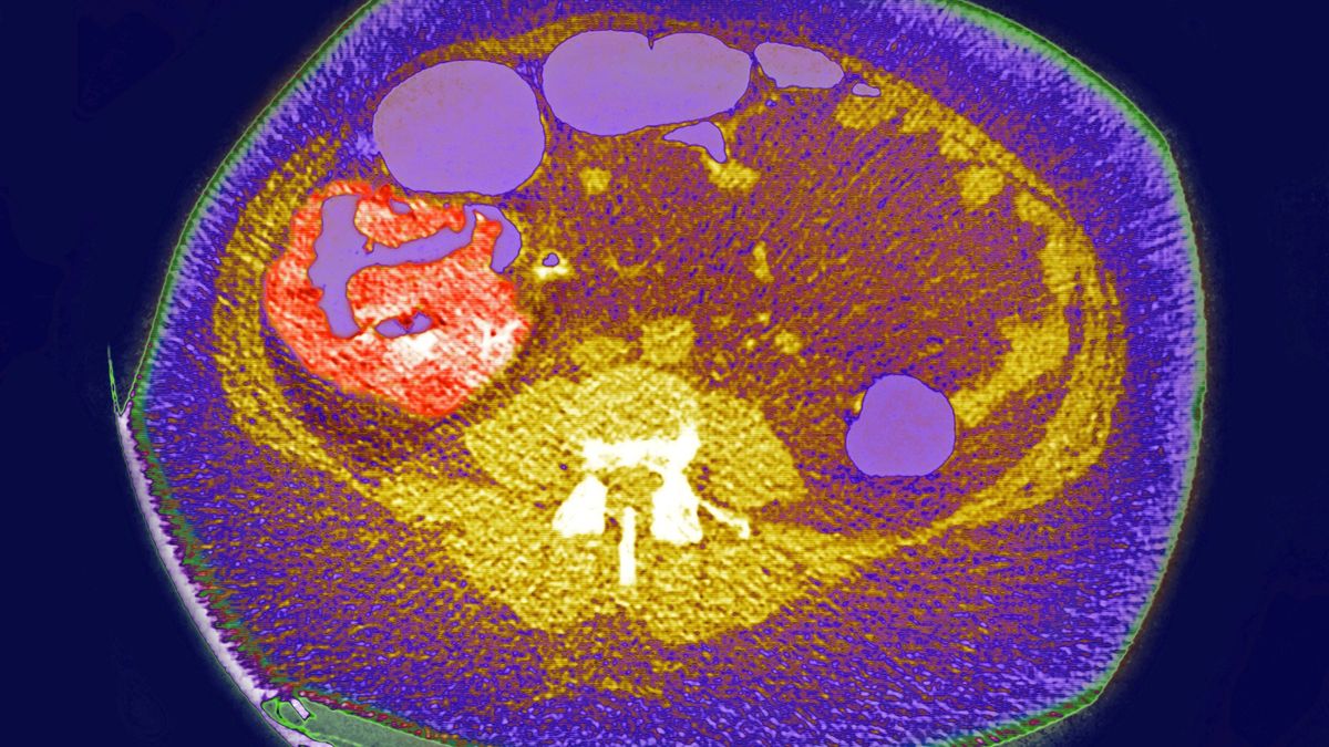 bowel-cancer-young-adults