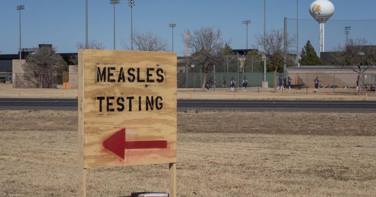 measles-outbreak-texas-doctor