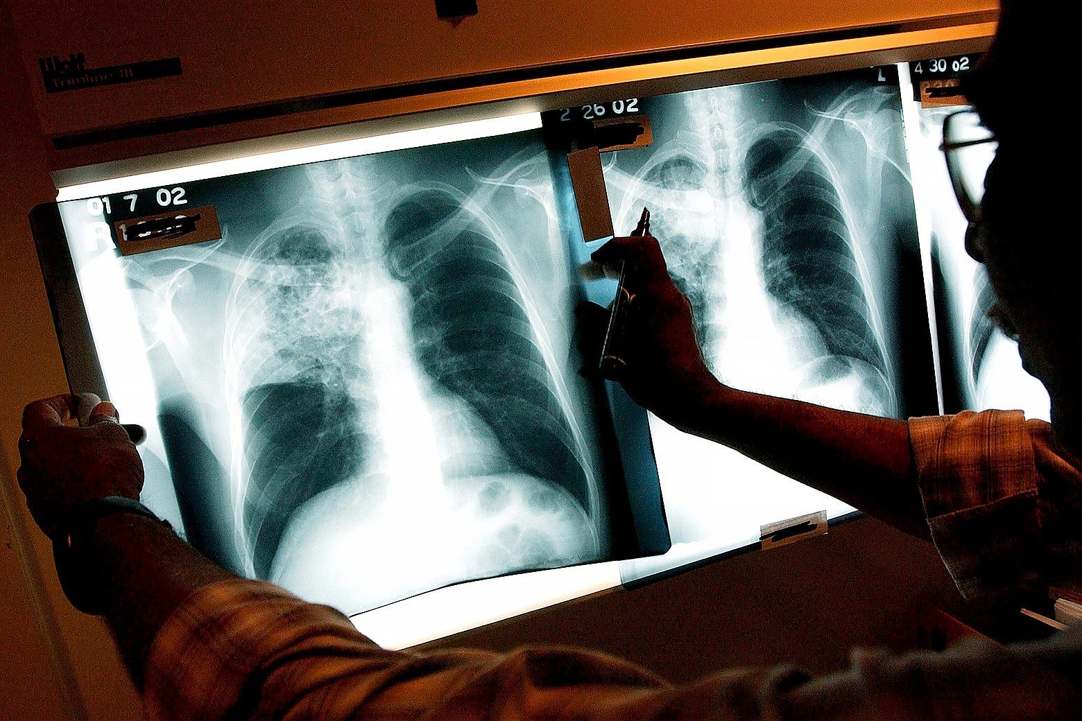 tuberculosis-resurgence-in-us