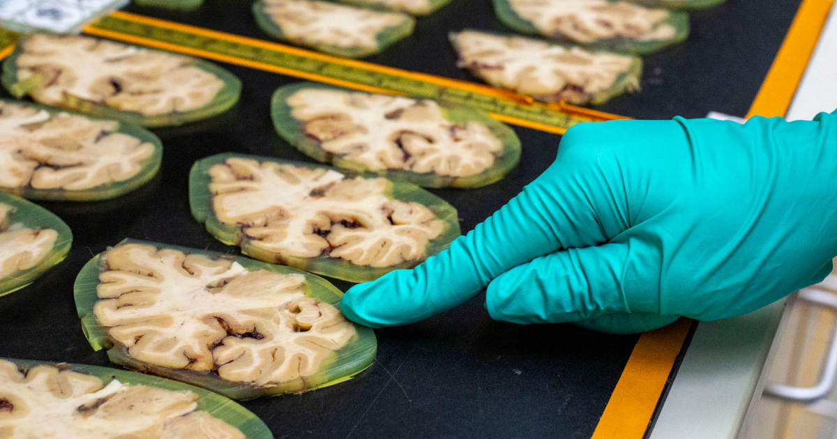 alzheimers-research-uncertainty