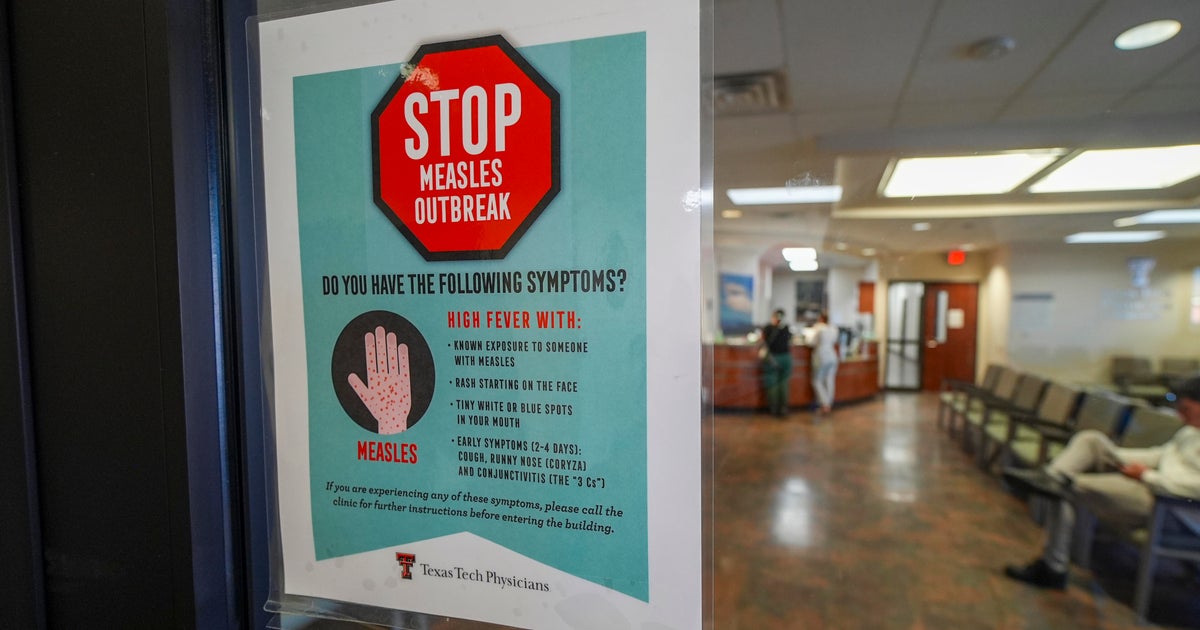 cdc-texas-measles-outbreak