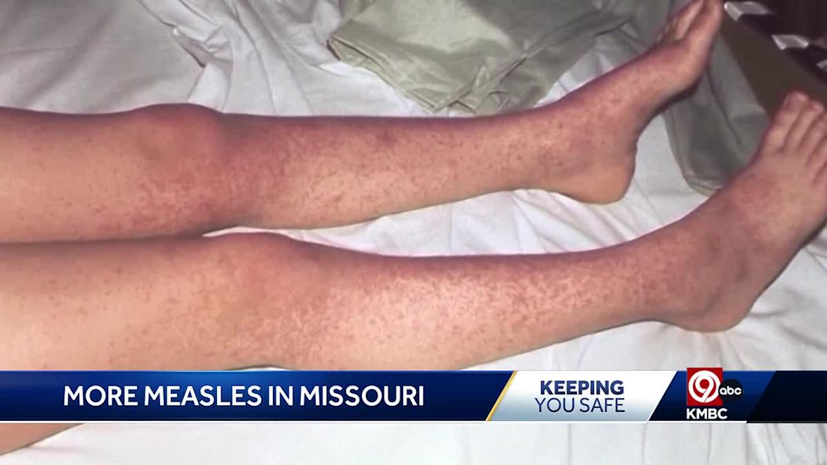 measles-exposure-missouri